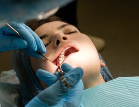 Wisdom Teeth Removal