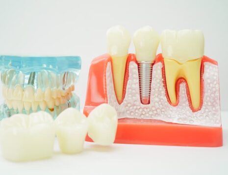 Single Tooth vs. Multiple Tooth Replacement
