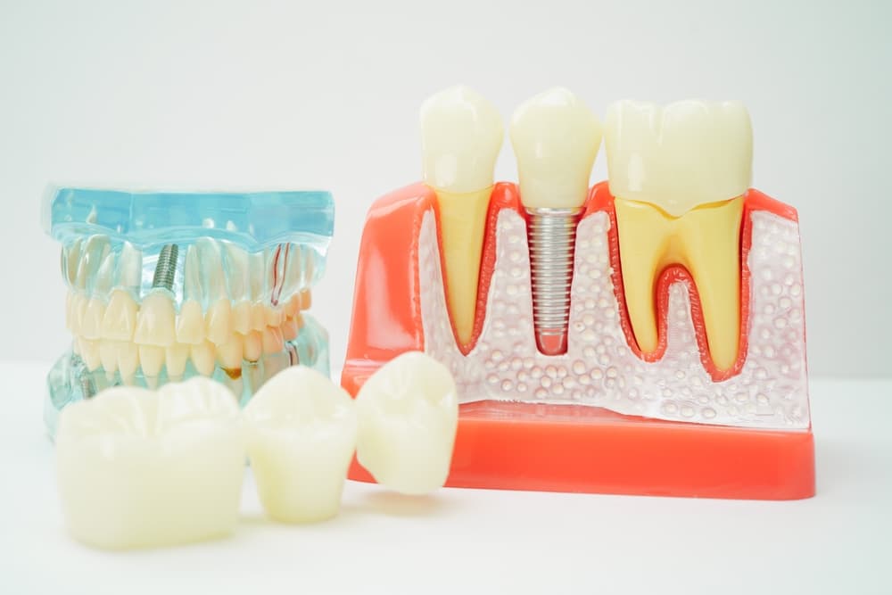 Single Tooth vs. Multiple Tooth Replacement