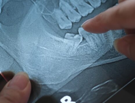 wisdom teeth removal