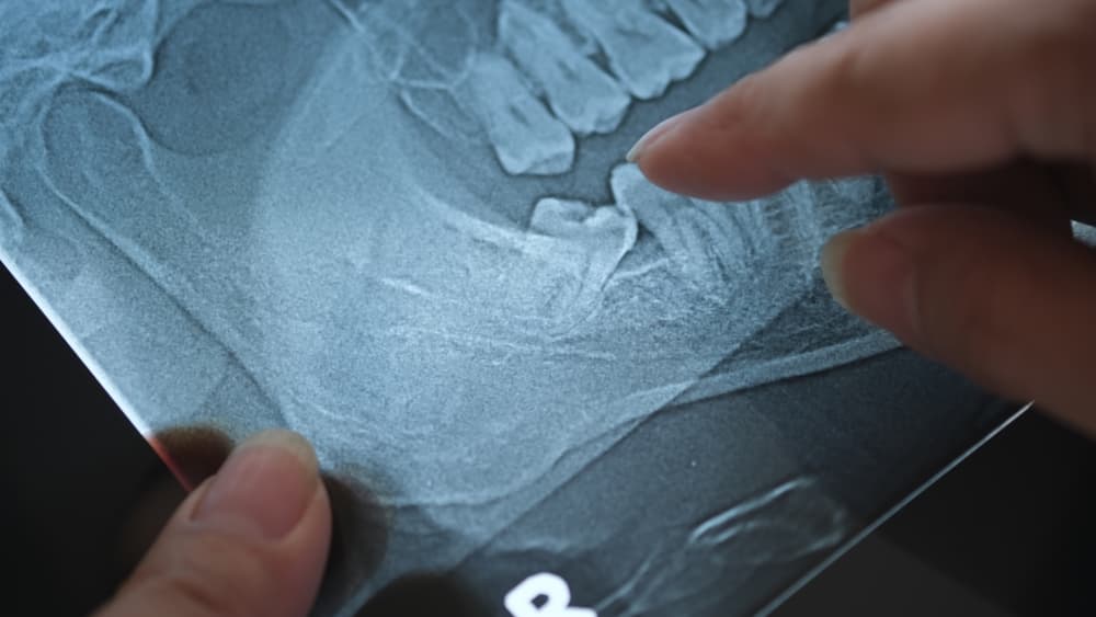 wisdom teeth removal