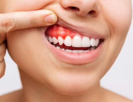 gum disease