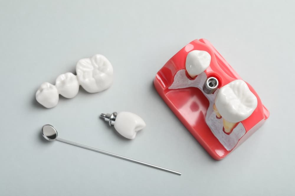 dental implants brisbane